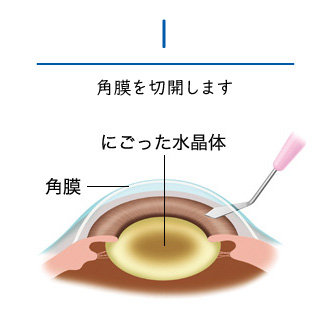 日帰りで受ける白内障手術|新発田の眼科「信田眼科医院」