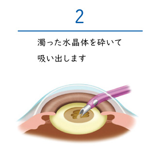 白内障の手術は身体の負担が少ない日帰り手術で