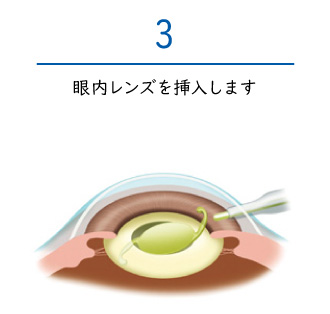 新発田市の信田眼科医院で受けられる日帰り白内障手術