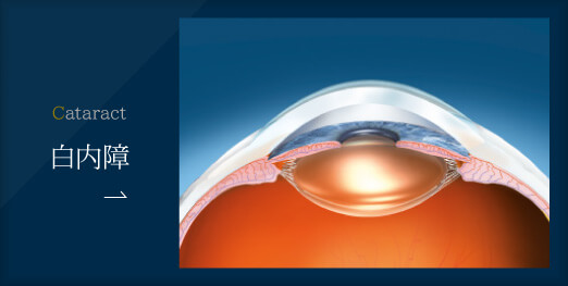 信田眼科医院で行う日帰り白内障手術について