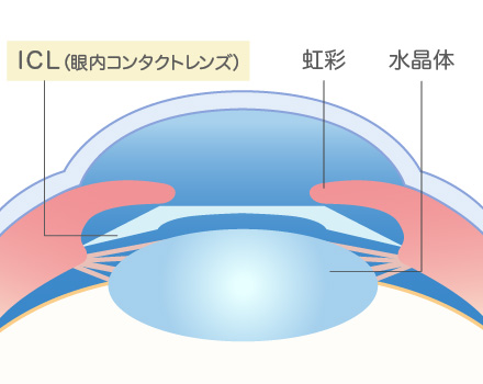 白内障の発症率をグラフにしています